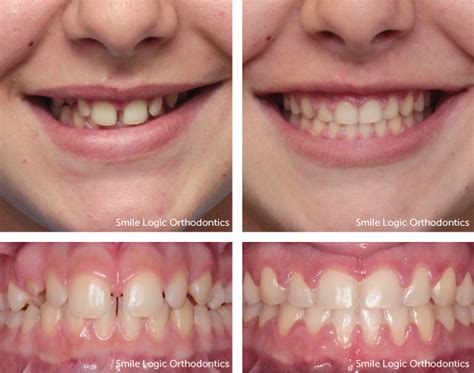 Before and After Braces Gallery · Dr. Viechnicki · South Brunswick NJ