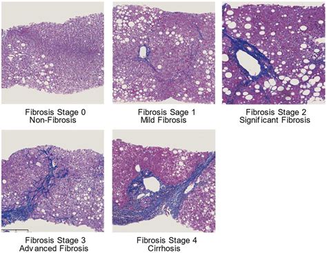 IJMS | Free Full-Text | Elastography Techniques for the Assessment of Liver Fibrosis in Non ...