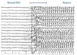 Photosensitive Epilepsy - Epilepsy Action Australia