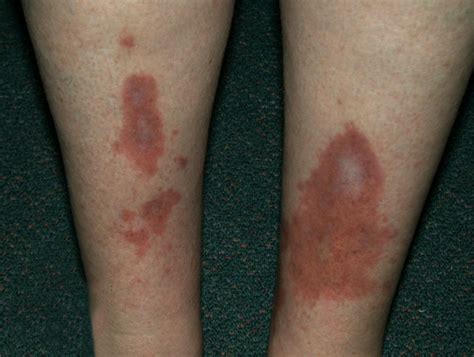 How Does Diabetic Skin Rash Look Like?