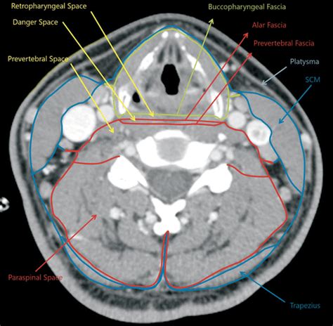 Prevertebral Space