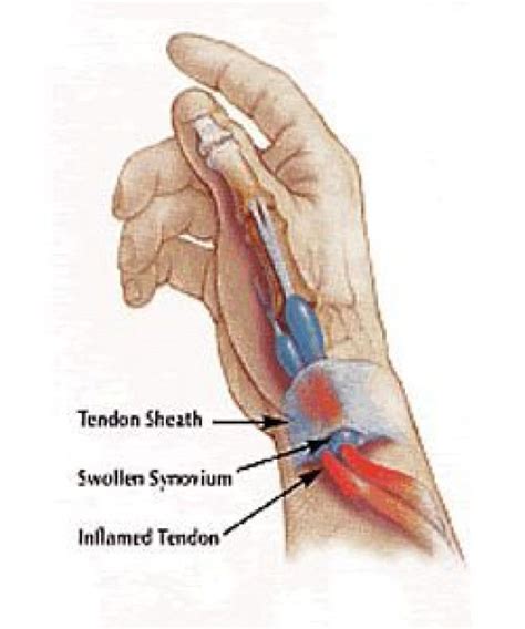 Tenosinovitis de Quervain-Quervains Tenosinovitis #chiropracticwellness #chiropractic #wellness ...