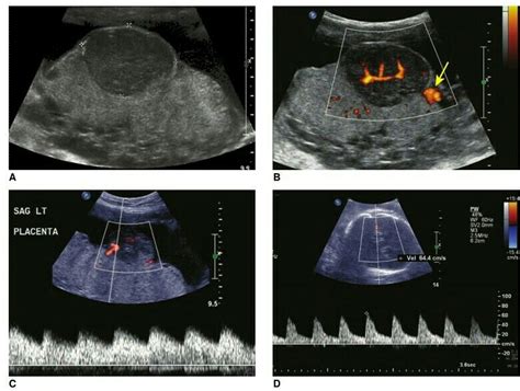 Evaluation of a chorioangioma by sonography. A: Evaluation of tumor ...