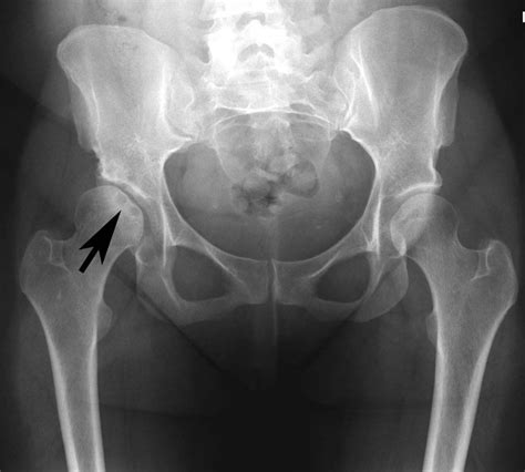 Living With Osteonecrosis