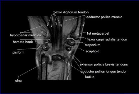 MRI wrist coronal anatomy | wrist tendon and ligaments anatomy | cross ...