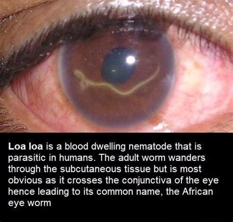 Loa loa is a blood dwelling nematode that is parasitic in humans. The adult worm wanders through ...