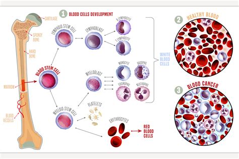 Leukemia medical infographic | Healthcare Illustrations ~ Creative Market