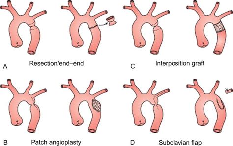 Coarctation Of The Aorta Repair