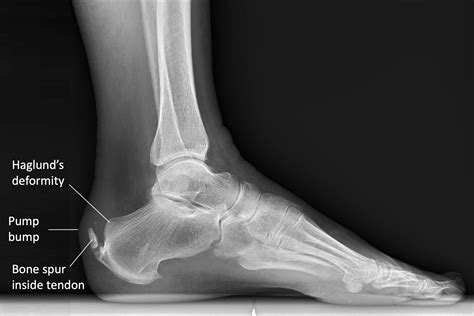 Calcaneal Spur Xray