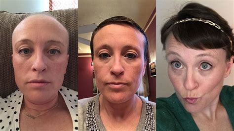 Hair Growth After Chemotherapy: Pictures and the Process