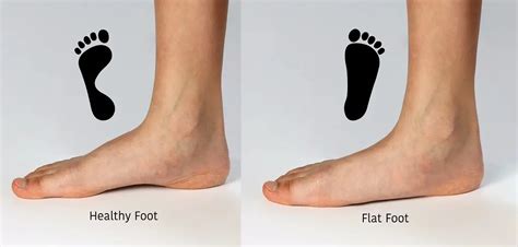 The Benefit’s of Orthotics – Step Away From Pain! – Physio Performance