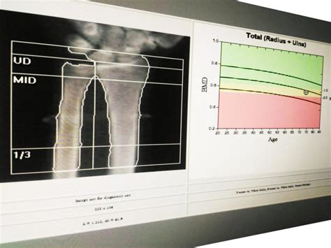 10 Facts About Bone Density Tests - Facty Health