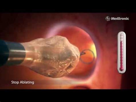 Medtronic's Arctic Front Advance® Cardiac CryoAblation Catheter system - YouTube