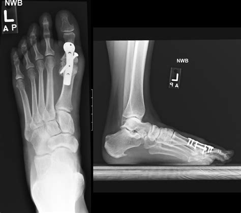 First MTP Joint Fusion | MTP Fusion Surgery Procedure & Recovery