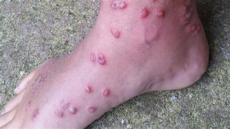 'Swimmer's itch' parasite in Delaware Bay burrows in skin, causes bumps