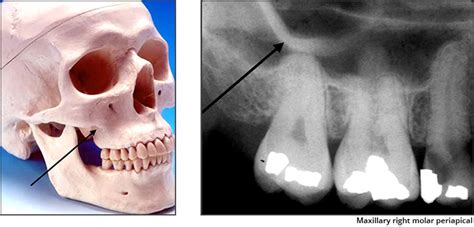 Zygomatic Process Radiograph