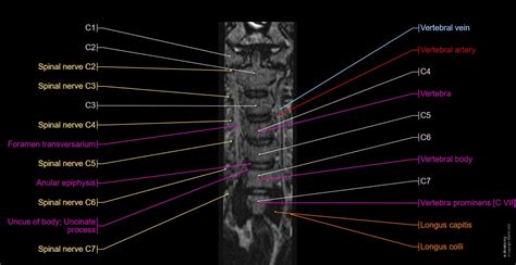 Mri Read Cervical Spine Axial View Anatomy Of Cervica - vrogue.co