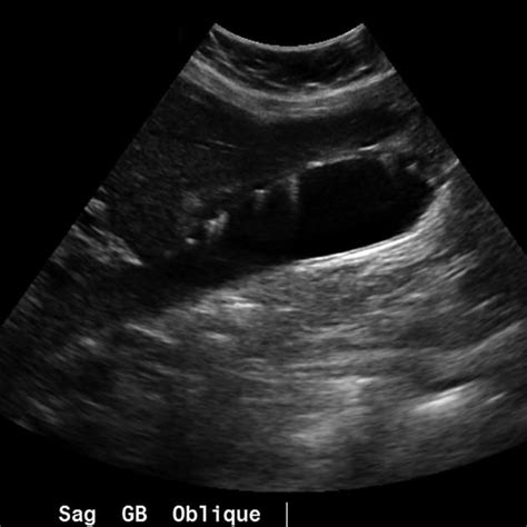 Adenomyomatosis of the gallbladder | Radiology Reference Article | Radiopaedia.org | Gallbladder ...