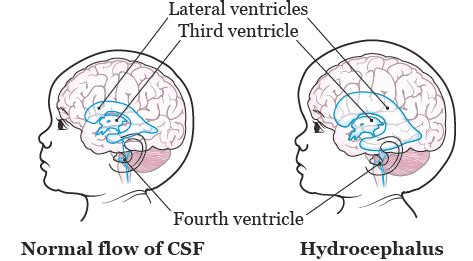 Programmable VP Shunt: Information for Children, Teens, and Young ...