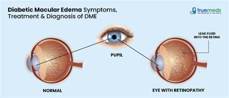 Diabetic Macular Edema