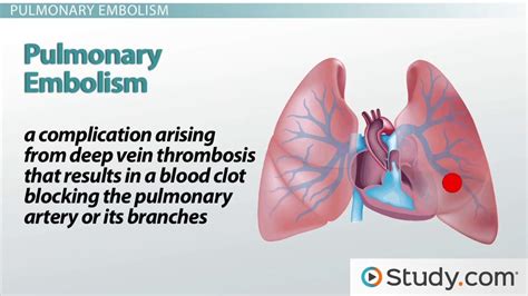 Pulmonary Embolism: What is it and Why Does it Occur? - Lesson | Study.com