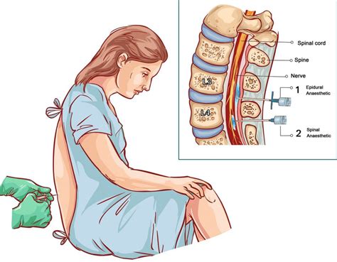 resistirse Higgins carga nerve block injection in back liderazgo para ...