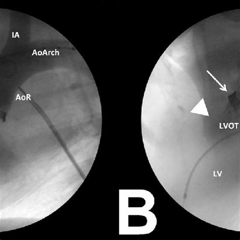 Photograph of annuloplasty ring segments healed into the aortic annulus ...