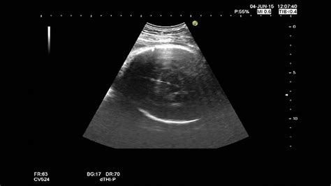 High Quality Ultrasound Echography Check. Gynecological Medical Examination. 33 Weeks Old ...