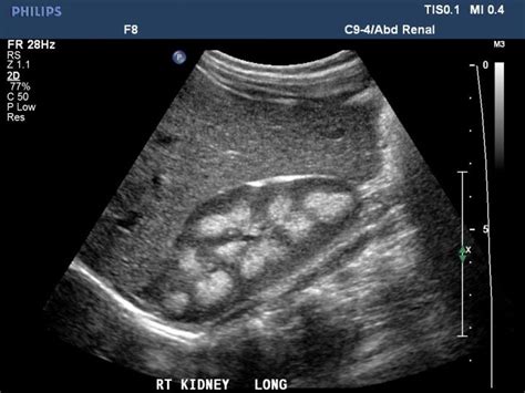 this is a all to common ultrasound of the MSK kidney | Ultrasound ...