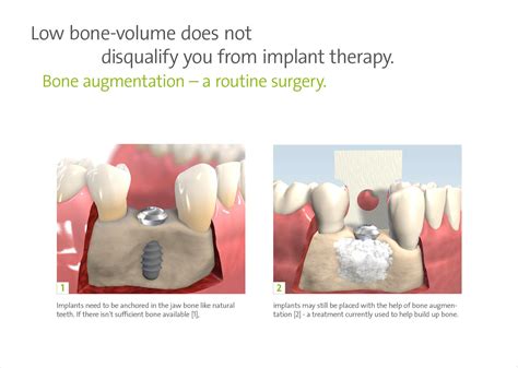 Bone augmentation — Kenyon Dental Implants