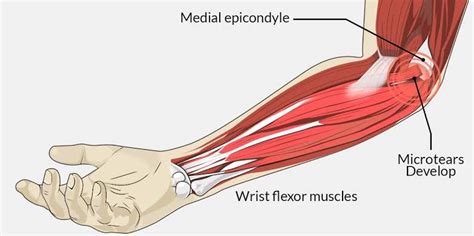 Sports injury conditions Golfer’s Elbow – The Body Rehab