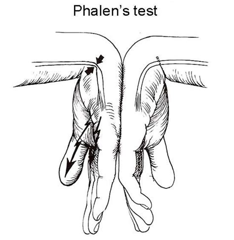 test de phalen