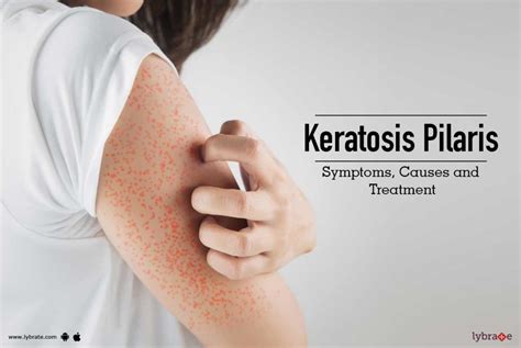 Keratosis Pilaris - Symptoms, Causes and Treatment - By Dr. Nivedita Dadu | Lybrate