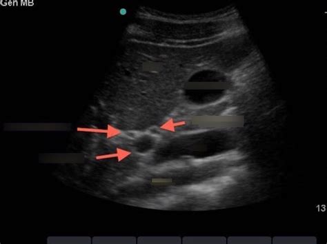 Hepatic Ultrasound Diagram | Quizlet