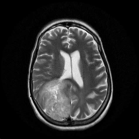 Glioblastoma: Last Stages Of Glioblastoma