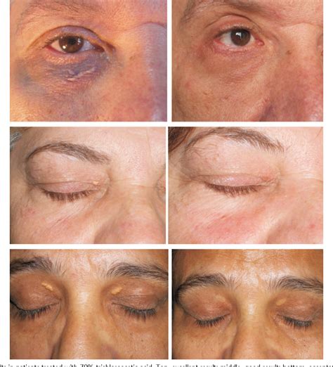 Treatment of eyelid xanthelasma with 70% trichloroacetic acid. | Semantic Scholar