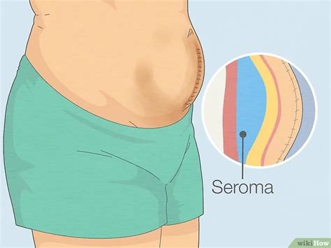 Seroma fluid removal - STL Post Op Care