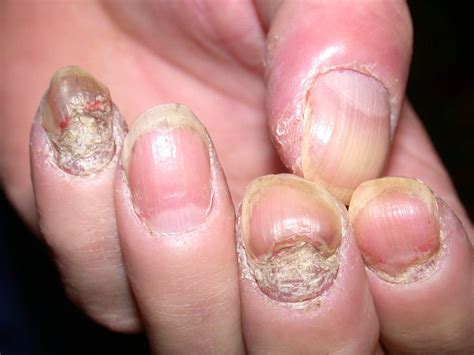 Nail psoriasis photos on the hands