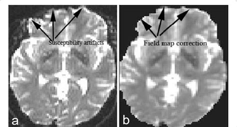 a) Shows susceptibility artifact in DTI data collected from one of our ...