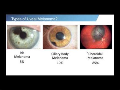 Ocular Melanoma: Innovative Treatments and Beyond - YouTube