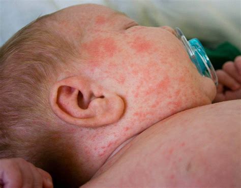 What to Do About Heat Rash in Babies: Should I Be Worried? - Step To Health