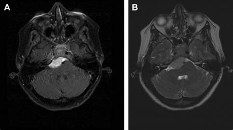 Petroclival Meningiomas | Ento Key