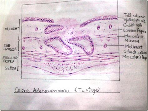 Histology Slides Database: Colonic Adenocarcinoma hand made ...