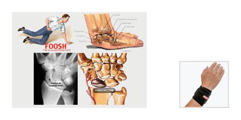 Ulnar Wrist Pain Causes