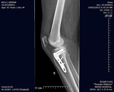 Tibial Plateau Fracture Surgery | Renew Physical Therapy