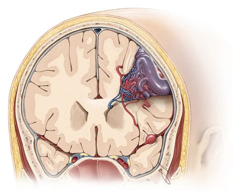 Avm Brain Hemorrhage