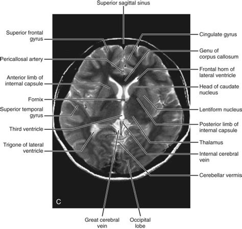 Hippocampus Anatomy Mri