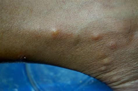 Close Up Around Ankle Of Woman With Rash Cause From Bed Bugs Bite Stock ...