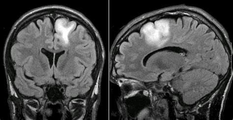 Glioma - low grade4a