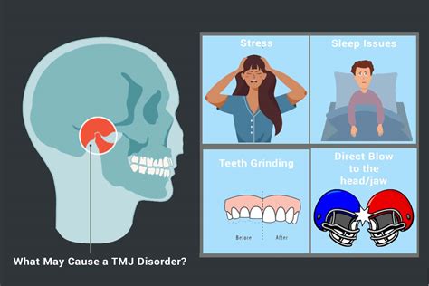 TMJ (Temporomandibular Joint) Disorders: Symptoms And More, 58% OFF